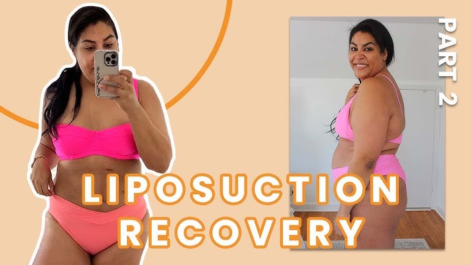 Carlene's Journey: Sono Bello Liposuction Recovery and 90 Day Body