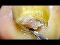 Ingrown Toenails Are Deeply Curled! Restore Healthy Toenails【Xue Yidao】