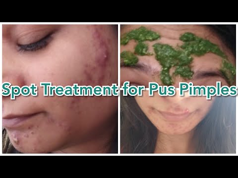 HomeMade Spot Treatment for Acne & Pimples (Say Bye Bye to Pus Pimples) | DIY with RJ
