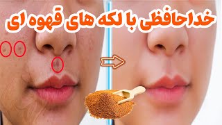 از بین بردن لک صورت با طب سنتی : درمان همیشگی لکه های قهوه ای صورت