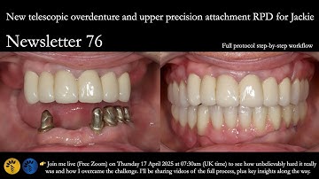 Study Club 12   Telescopic overdenture & upper precision attachment RPD for Jackie