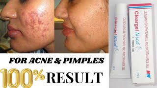 Clear Gel Cream| Clear gel Cream uses in Hindi| Acne Treatment| Pimples Removal| Acne Removal