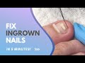 Ingrown toenail treatment tutorial  how to fix ingrowns with onyfix