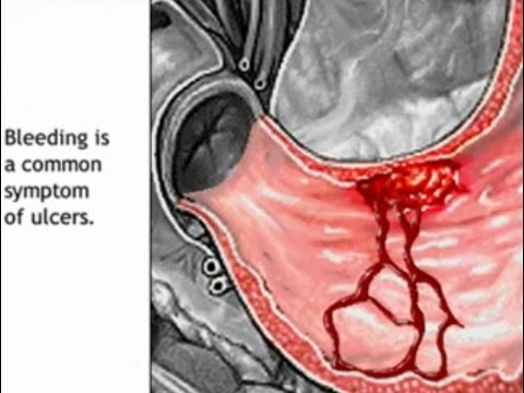 Are the symptoms of a duodenal ulcer painful?