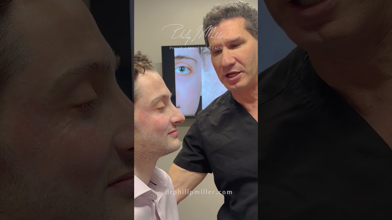Two weeks post Rhinoplasty