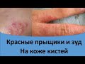 Красные прыщики и зуд на кистях