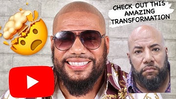 SECOND SESSION SCALP MICROPIGMENTATION. CRAZY TRANSFORMATION 🤯. INFUSION.SMP