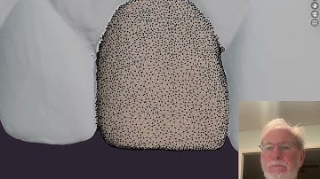 AI Segmentation of teeth  from intra oral scans