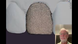 AI Segmentation of teeth  from intra oral scans