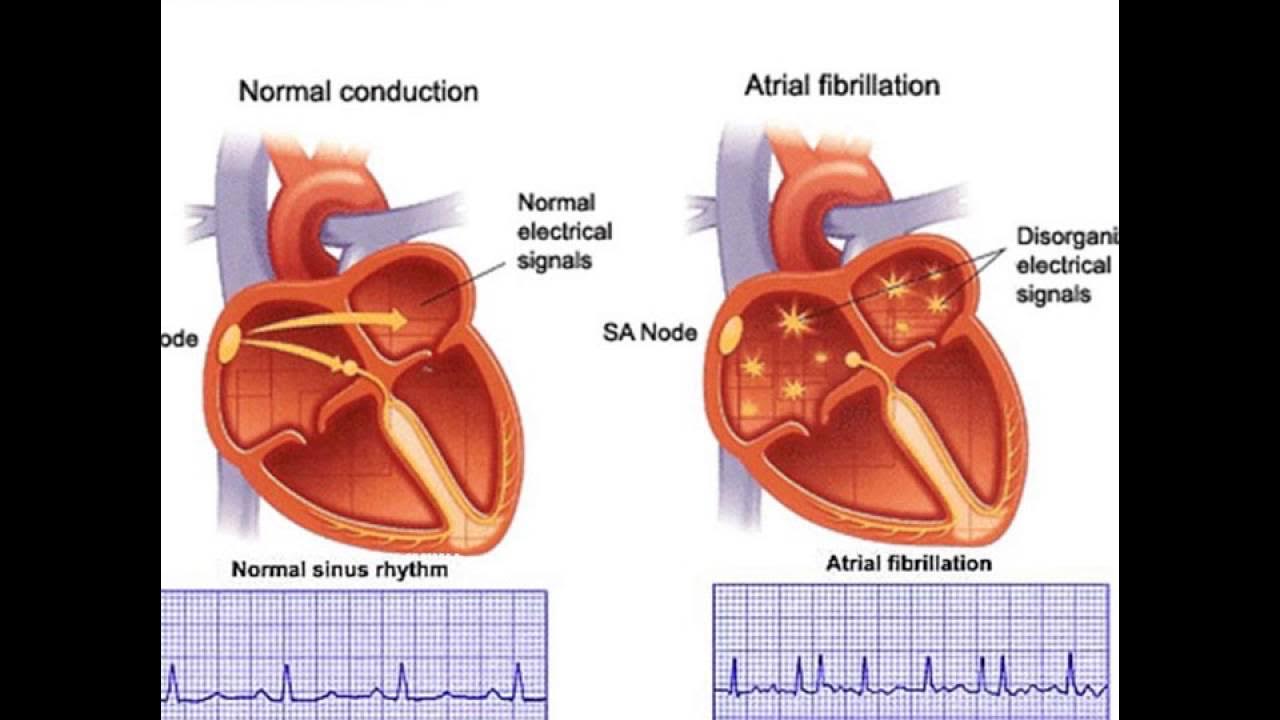 Нарушение сердечного ритма. Заболевания сердца аритмия. Больные сердечно-сосудистыми заболеваниями. Сердечный сбой. Нарушение ритма сердца мерцательная аритмия.