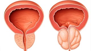 prostatita cu pietre plante benefice prostata