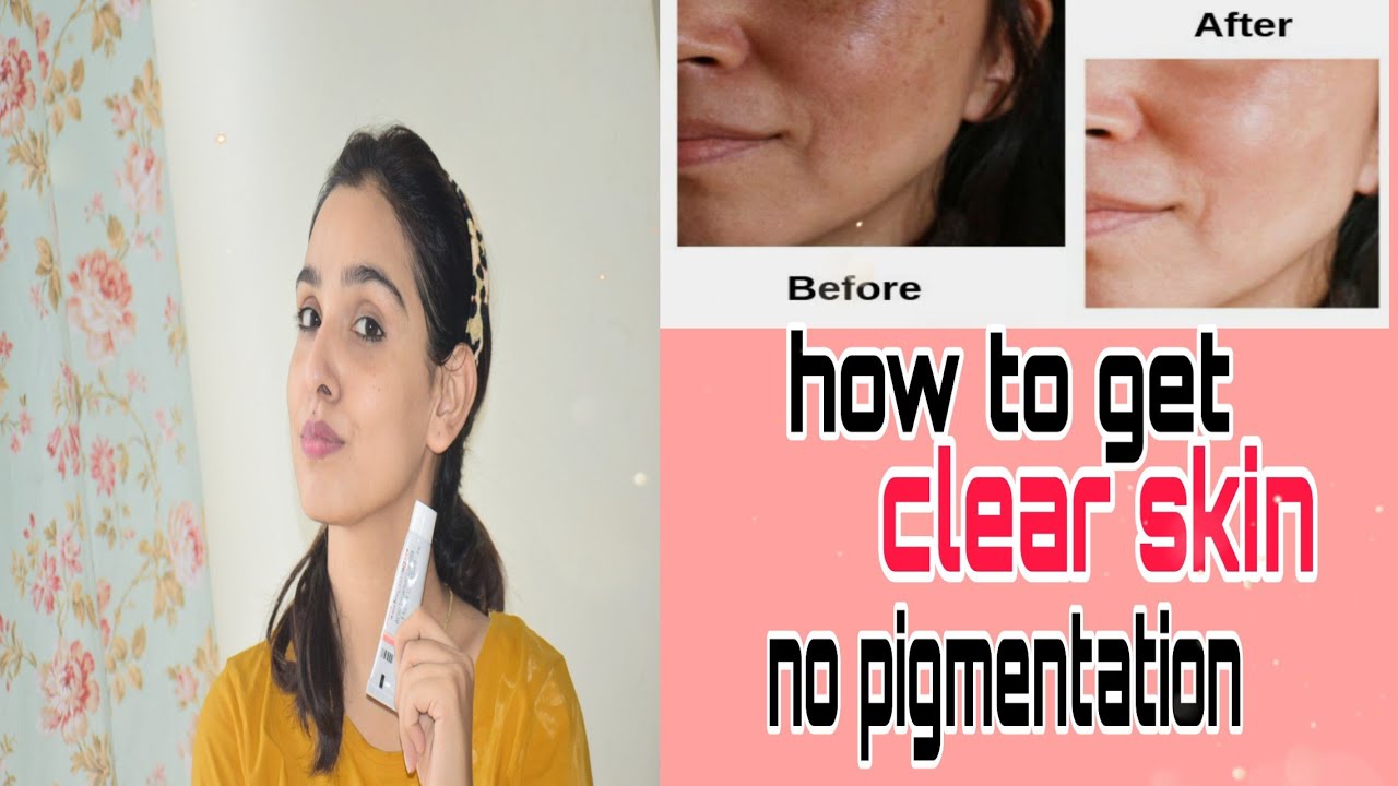 demelan cream for hyperpigmentation