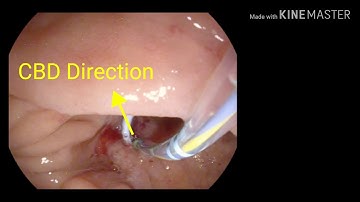 ERCP : Trans-PD Stent Cannulation - TWFC