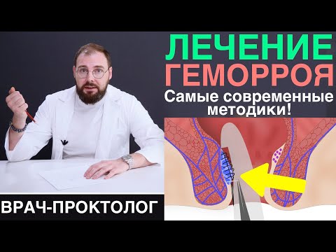 Лечение геморроя - операция Hal-rar, латексное лигирование, удаление лазером, Миллигана-Моргана