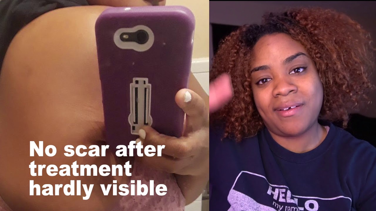 Cure Ringworm in two ways - YouTube