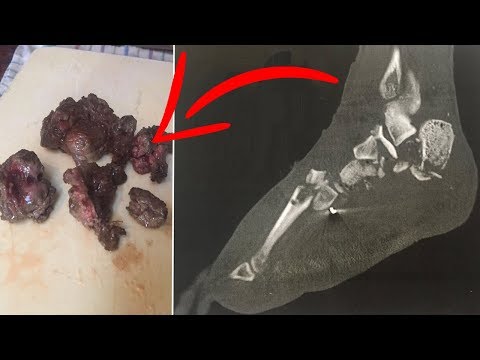 Man Eats Own Amputated Foot With Friends