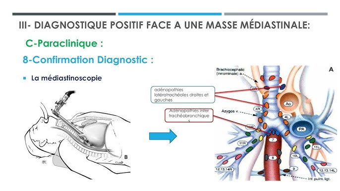 La pathologie tumorale médiastinale : Démarche Diagnostic et ...
