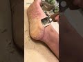 Extreme callus shaving removal asmr pedicure  hyperkeratosis eppk foot  nov 10 2023