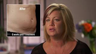 SculpSure™ Patient Testimonials