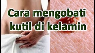 Download Cara Mengobati Kutil Di Kelamin Secara Alami Tanpa Efek Samping Video MP3 Cara Mengobati Kutil Di Kelamin Secara Alami Tanpa Efek Samping