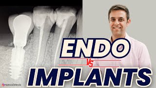 Endodontics vs Implants with Omar Ikram - PDP238