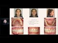 Dental Treatment: Accelerated Orthodontics Feb 18, 2021
