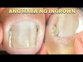 Big ingrown  toenail relief satisfying removal 