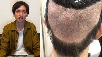 地毛植毛 Youtube