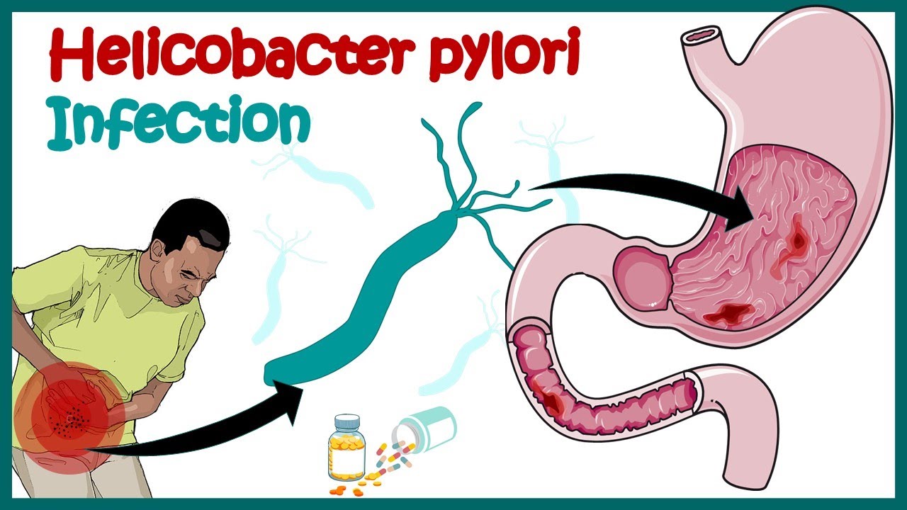 Helicobacter Pylori Infection | Gastric Ulcer | Causes, Signs And Symptoms, Diagnosis And Treatment.