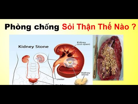 Bệnh Sỏi Thận  Và Cách Phòng Chống