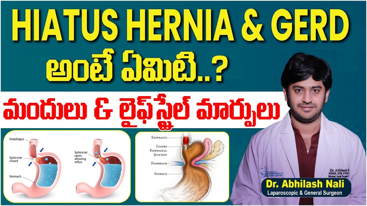 Hiatus Hernia Treatment | Symptoms, Causes & Management | Dr Abhilash Nali