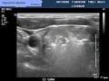 Rfa soft tissue ultrasound