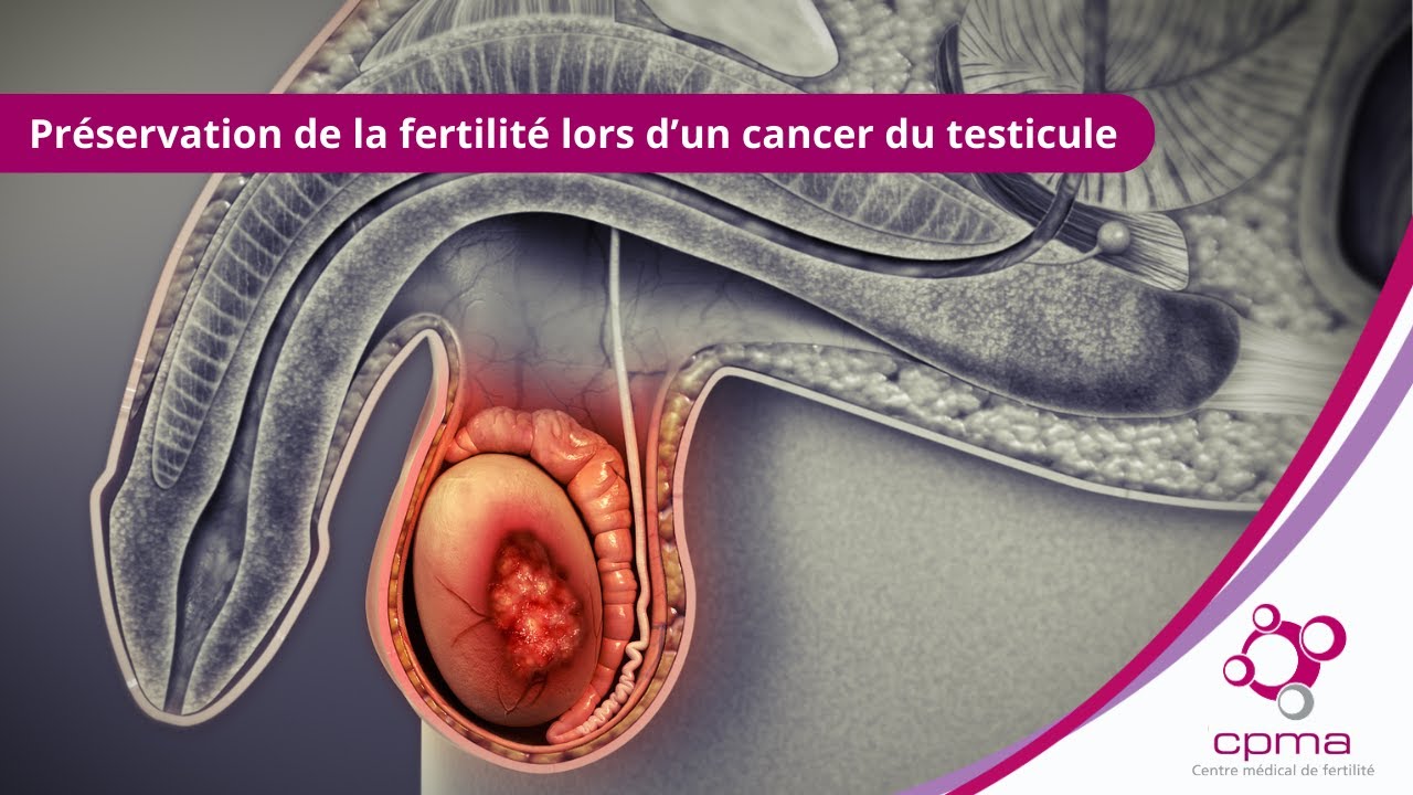 Préservation de la fertilité lors d'un cancer du testicule | Interview Dr  Lionel Micol | CPMA