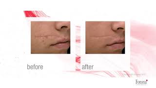Scar Revision By Laser Physimed Medispa