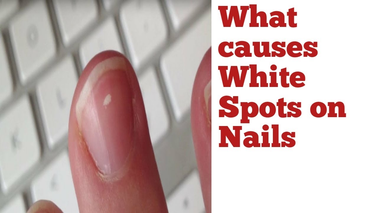 Split Nails: Pictures, Causes, and Treatments