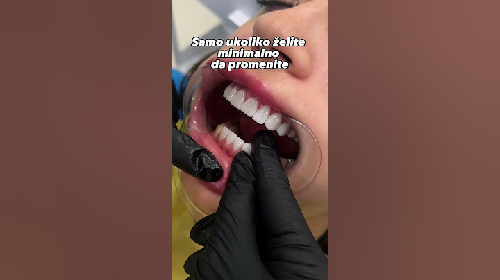 Da li biste i vi radili fasete? #dentist