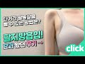 바비라인 팔지방흡입 1주일,1개월,3개월 경과 리얼후기영상💚