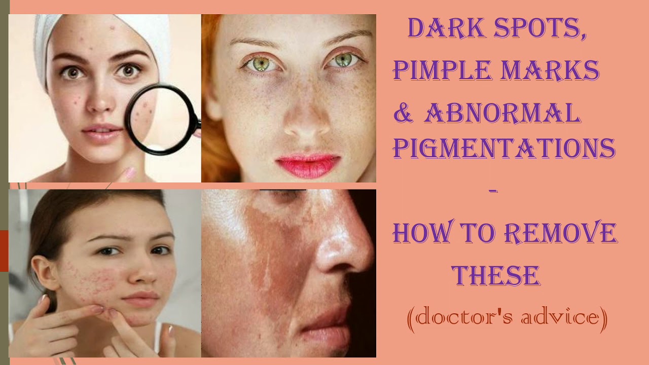 What Kind Doctor Remove Spots On Face