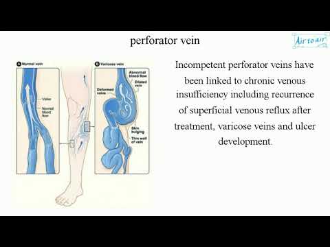 Video: Nekompetentní perforátory v léčbě nohou?
