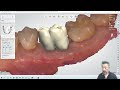 DentalSystem実演パート9 ! IOSでヘミセク大臼歯を設計する方法Newver.