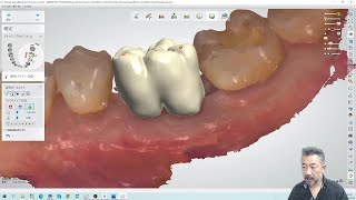 DentalSystem実演パート9 ! IOSでヘミセク大臼歯を設計する方法Newver.