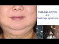 difference between Cushing's disease and Cushing's syndrome// by sajad