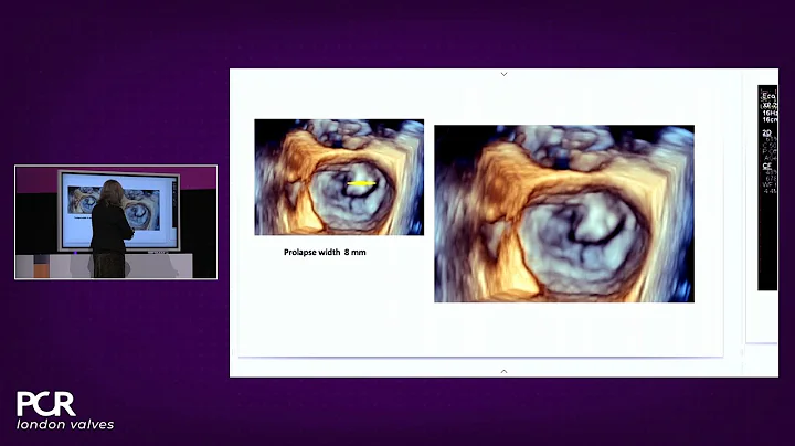 Advancing valve repair: mastering diverse mitral and TR anatomies with the PASCAL Precision system