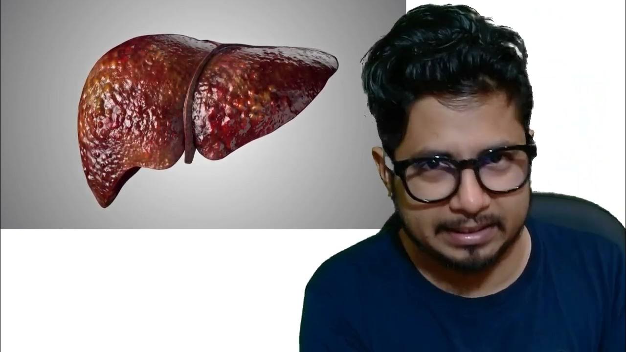Liver damage from alcohol Fatty liver, liver cirrhosis, liver