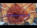 Rectal Atresia&Transanal End-to-End -AnoRectal  Anastomosis