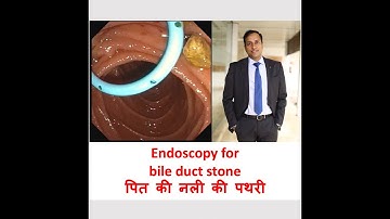 ERCP CBD stone, पित की नली की पथरी, Vikas Singla, Director, Gastroenterology, Max, Delhi.
