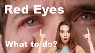 Bloodshot Eyes  What to do? How to treat Eye Redness and Home Remedies.