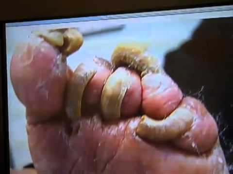 What is a fungal nail infection?-Minnesota Podiatrist Explains  www.innovativefootcare.com