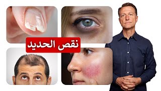 علامات نقص الحديد عليكم ملاحظتها على الجلد والشعر والاظافر وأفضل طعام على الاطلاق لتعويض الحديد