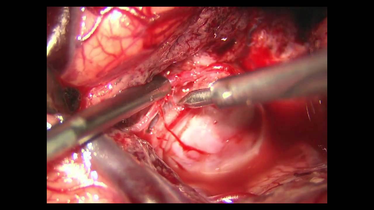 MCA fusiform aneurysm clipping that required EC-IC Bypass by Jon White ...